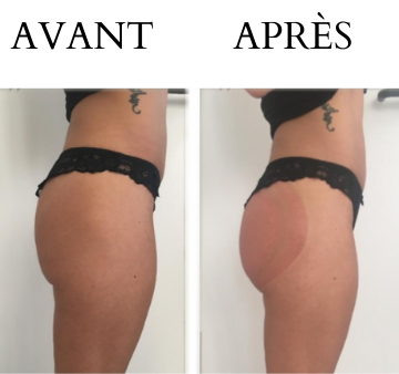 effet naturel lifting colombien